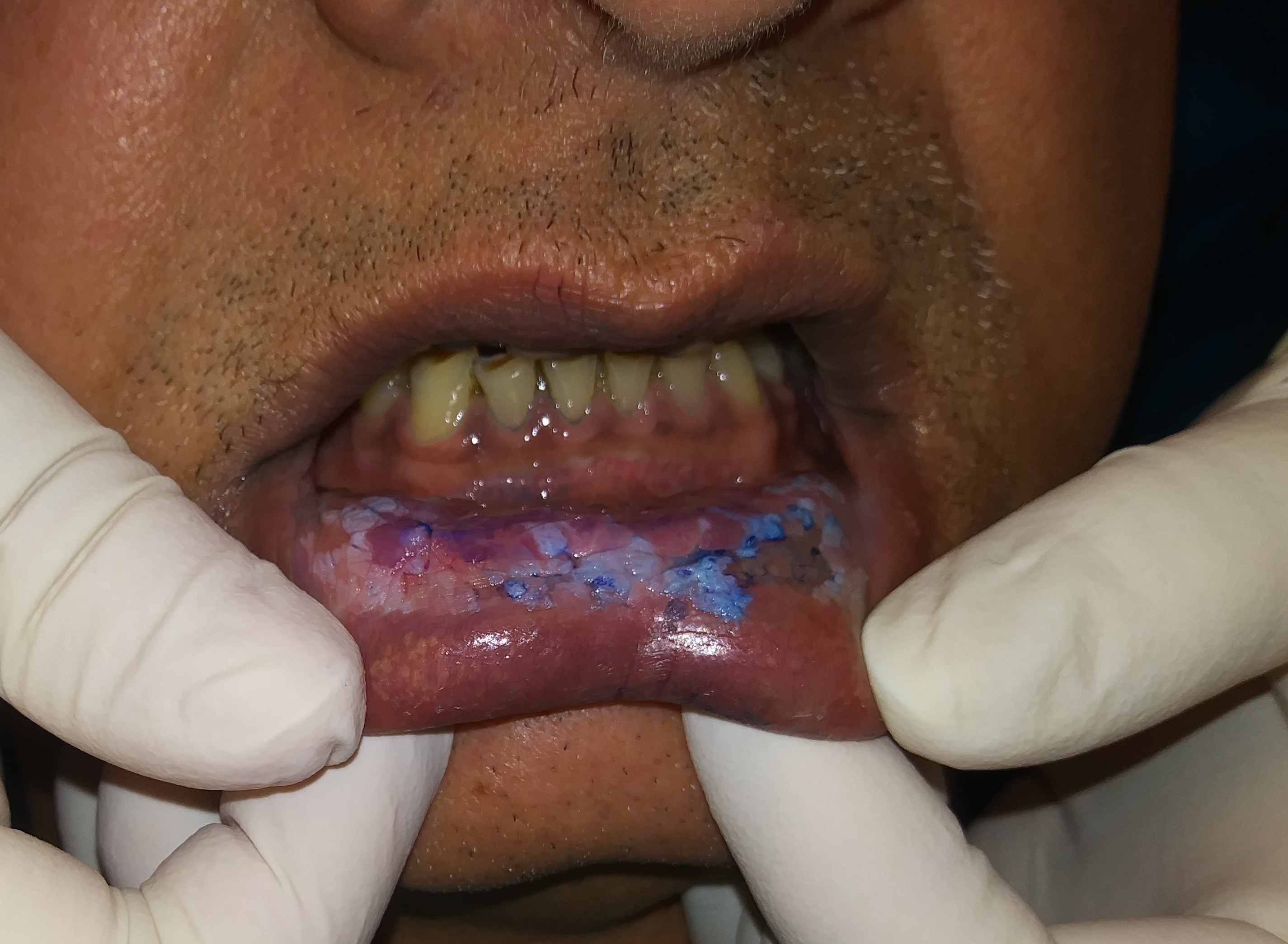 Mouth Staining