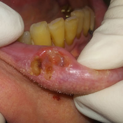 Treatment for Mouth Ulcers